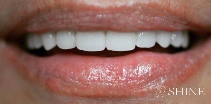 After dental treatment