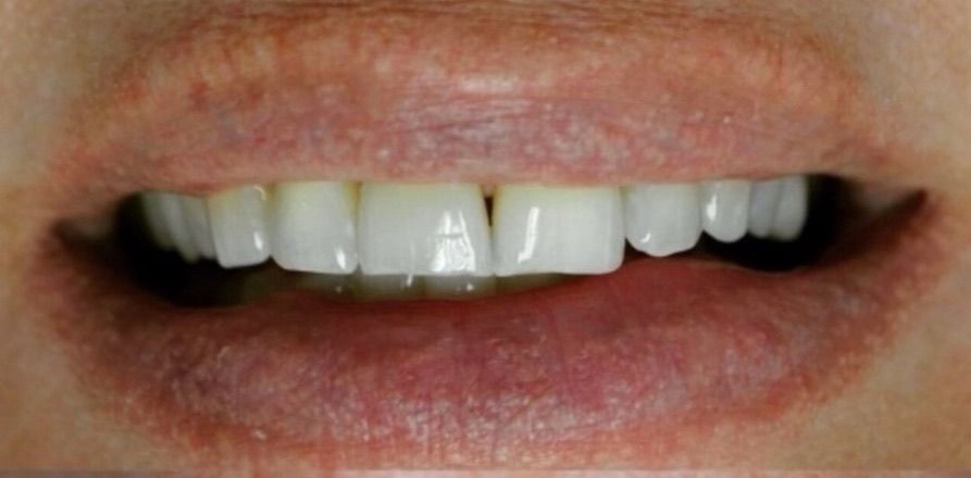 Before dental treatment